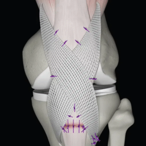 Gân nhân tạo tái tạo dây chằng Poly-Tape các cỡ